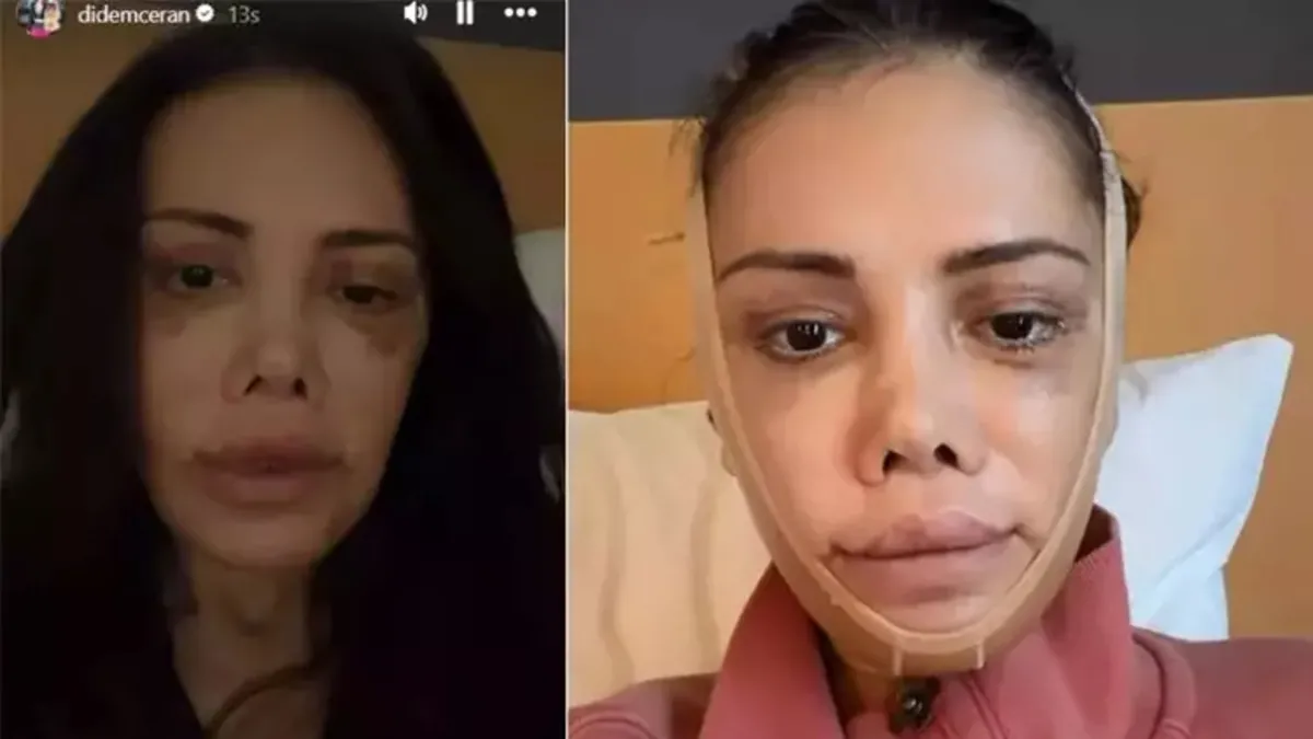 Yüz nakli olmuştu! Kendisini dünyaca ünlü yıldızla karşılaştırdı!