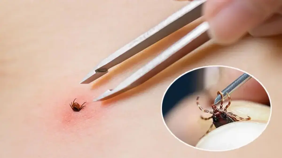 Sivas'ta kene alarmı! KKKA şüphesiyle tedavi gören 129 hastadan 10'u yaşamını yitirdi