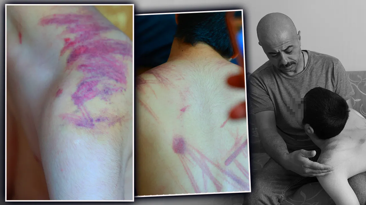 Ense, sırt, omuz… Her yeri mosmor! 14 yaşındaki otizmli çocuğa eğitim merkezinde darp