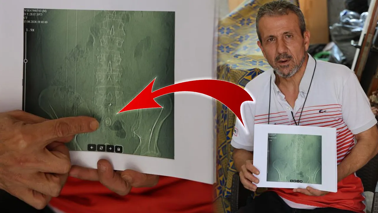 Ameliyat oldu, hayatı karardı! Belinde kalan parçayı çıkarmaya hiçbir doktor yanaşmıyor